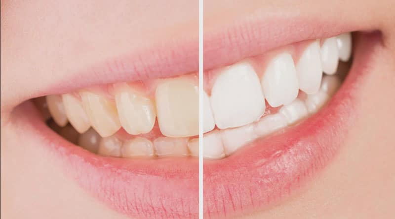 coffee stains from teeth natural ways